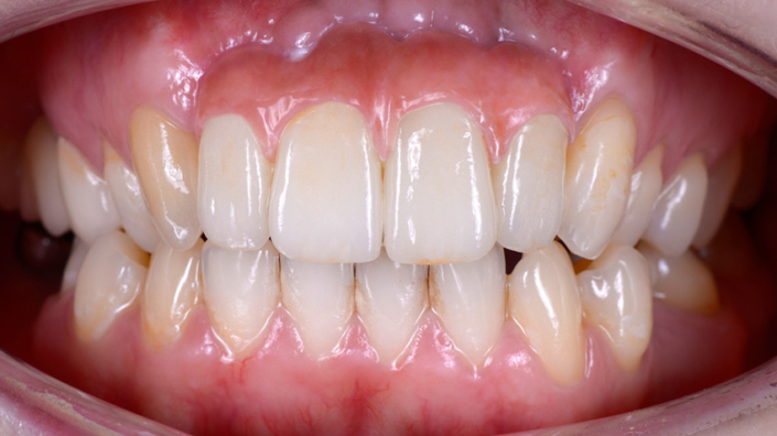 Zahnersatz Frontzähne